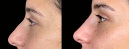 Non Surgical Nose Job Miami 17