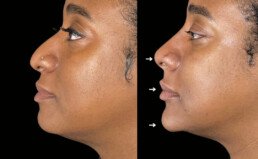 Non Surgical Nose Job Miami