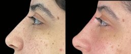 Non Surgical Nose Job Miami 21