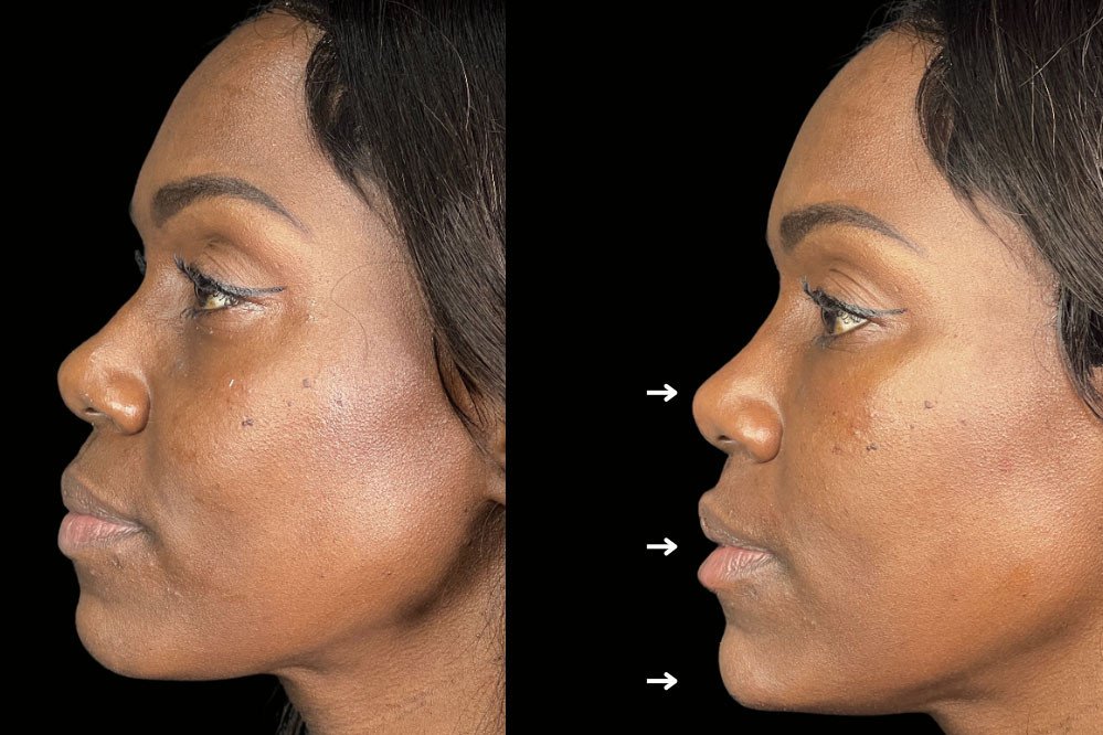 Non Surgical Nose Job Miami 23