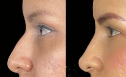 Non Surgical Nose Job Miami 24