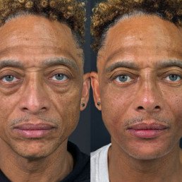 facial balancing west palm beach 71 Facial Balancing west palm beach